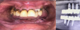Full Mouth Rehabilitation - Before