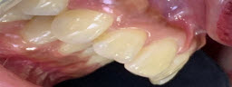 Jetting out teeth correction with intentional RCT and Metal free Crowns - Before