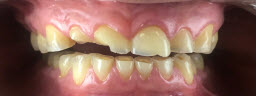 Full Mouth Rehabilitation with Metal Free Crowns To Restore Chipped, Fractured and Missing Teeth - Before