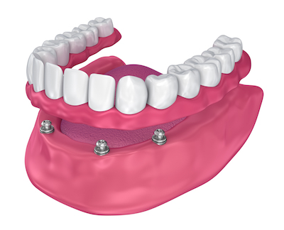 Implant Supported Overdenture