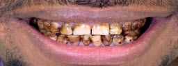 Full Mouth Rehabilitation with Metal Free Crowns - Before