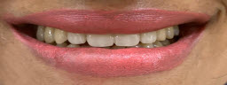 Smile Makeover with Gap Closure Treatment - After