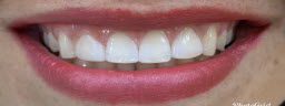 When Patient wants only front four to be treated . Gap closure with Composite Bonding - After