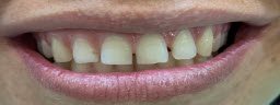 When Patient wants only front four to be treated . Gap closure with Composite Bonding - Before