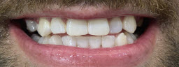 Zoom Whitening - After