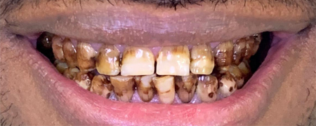 Full Mouth Rehabilitation With Metal Free Crowns