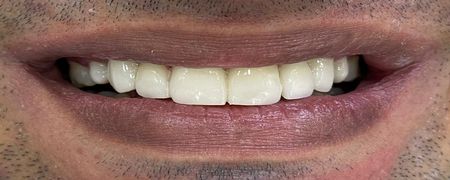 SMILE+MAKEOVER+WITH+PORCELAIN+VENEERS