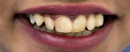 SMILE MAKEOVER WITH PORCELAIN VENEERS