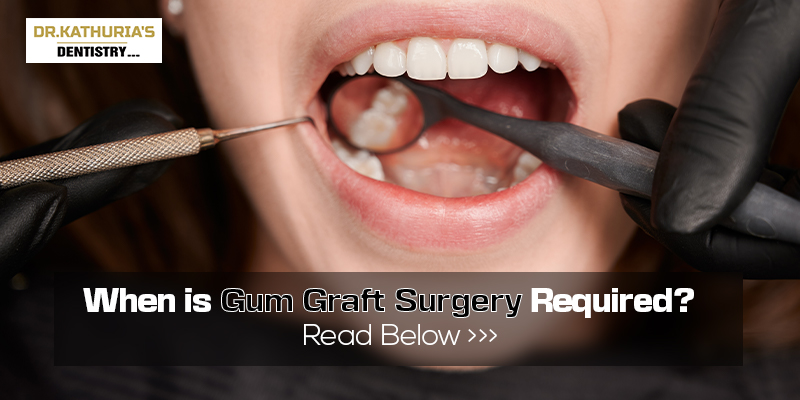 When is Gum Graft Surgery Required?
