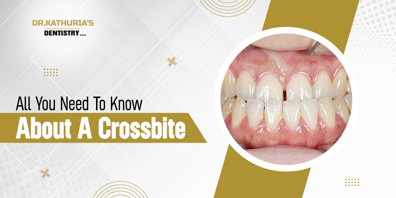 ll You Need To Know About A Crossbite