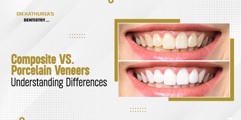 Composite vs. Porcelain Veneers