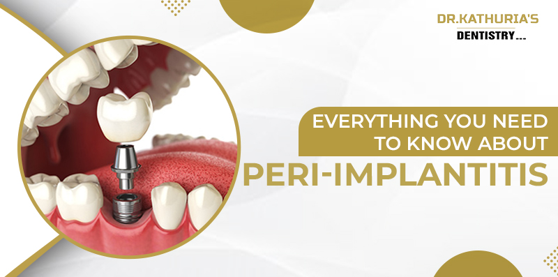 Peri-Implantitis