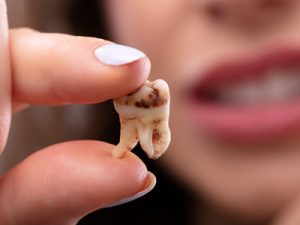 What Causes Tooth Decay