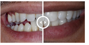 Clear Aligners Before and After Picture