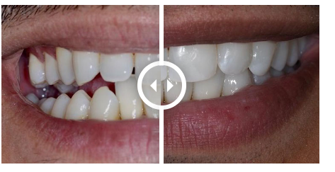 Smile Transformation: Clear Aligners Before and After | Delhi Dental