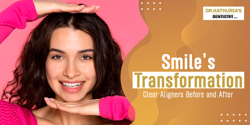 Smile's Transformation: Clear Aligners Before and After 2. Cosmetic Dentistry: Explore Procedures, Treatments, and Risks 3. How Dental Implants can Change Everything For You 4. Invisalign: Your Solution for How to Correct Teeth Gaps