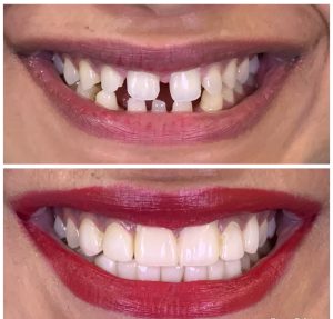 GAP CLOSURE WITH PORCELAIN VENEERS