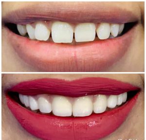 GAP CLOSURE WITH PORCELAIN VENEERS