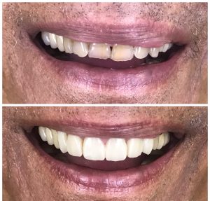 GROUNDED TEETH RESTORED WITH COSMETIC DENTISTRY