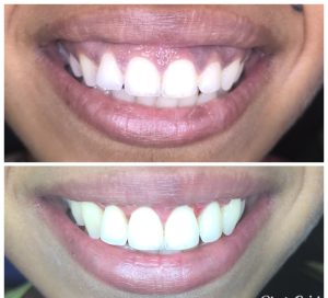 GUMMY SMILE CORRECTION & SMILE MAKEOVER