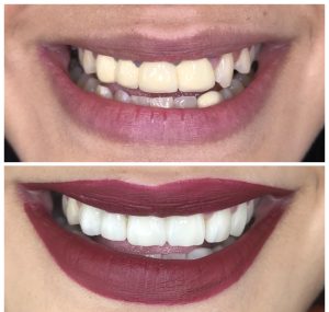 OLD CROWNS REPLACED WITH METAL FREE ZIRCONIA CROWNS