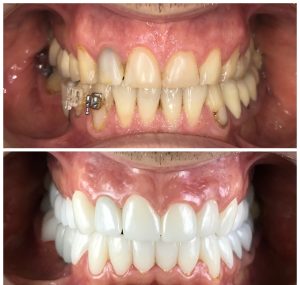 PERMANENT BRIGHTER TEETH WITH FULL MOUTH VENEERS/ CROWNS