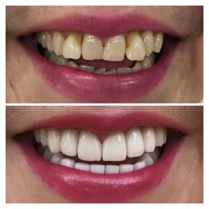 SMILE DESIGNING WITH PORCELAIN VENEERS