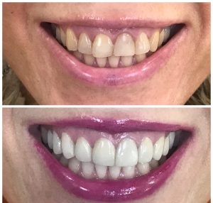 SMILE ENHANCEMENT WITH PORCELAIN VENEERS