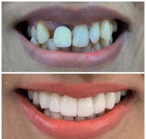 SMILE MAKEOVER WITH METAL FREE CROWNS & VENEERS