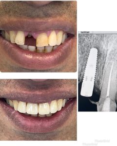 Men Single upper teeth replaced