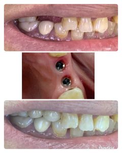 Double Tooth Restored With Dental Implant