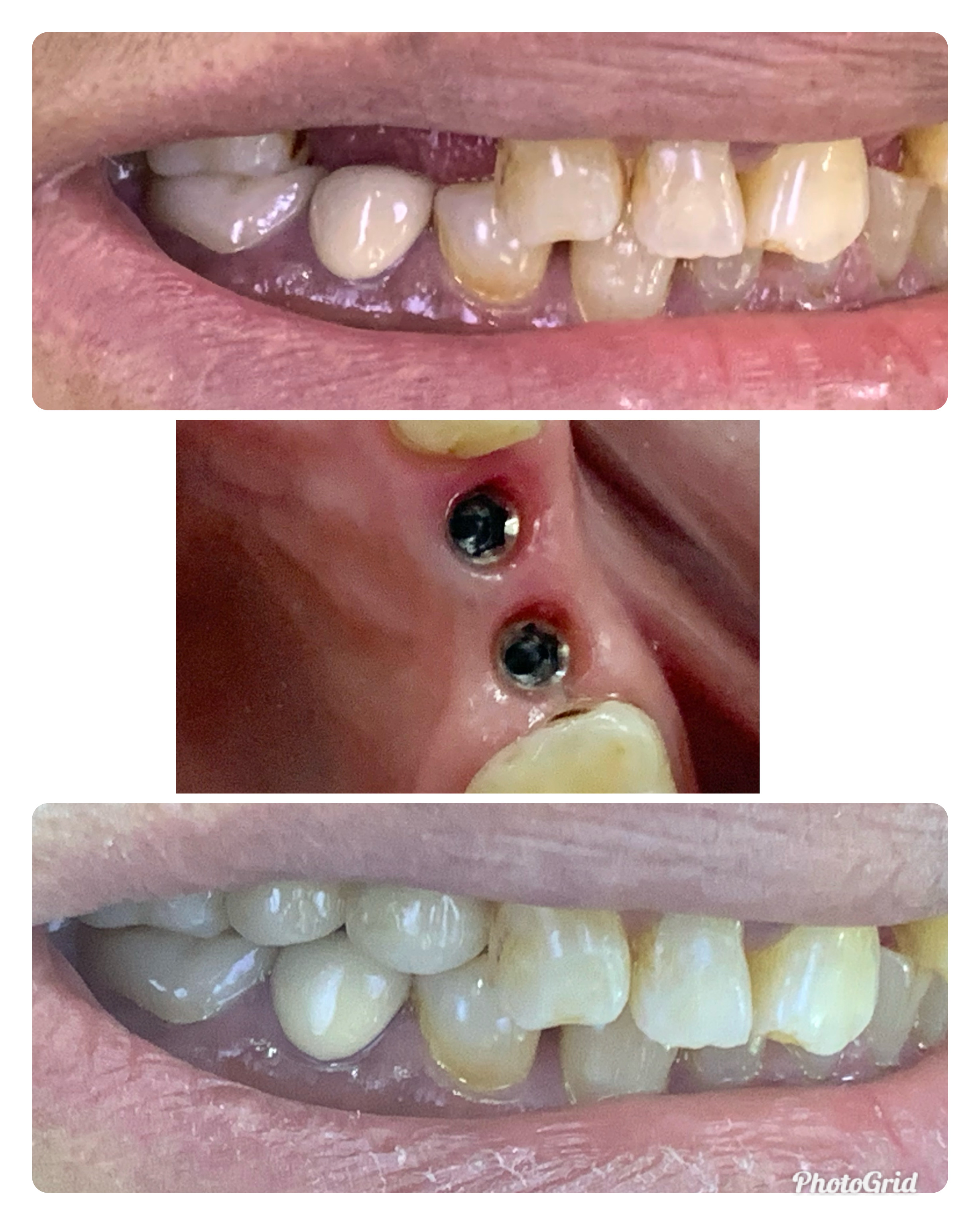 Double Tooth Restored - Before After