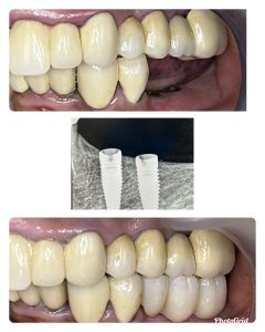 Lower Double Tooth Restored With Dental Implant