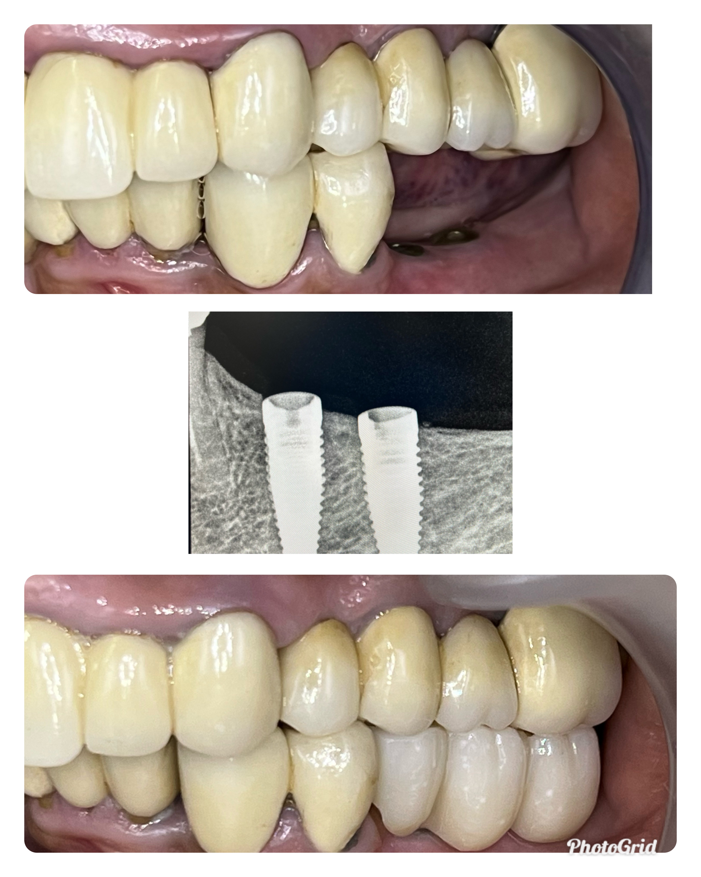 Dental Implant Case