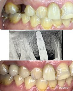 Single upper side teeth replaced