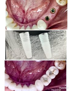 Lower Double Tooth Restored With Dental Implant