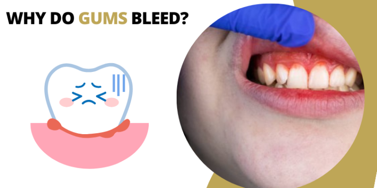 Why do Gums Bleed?
