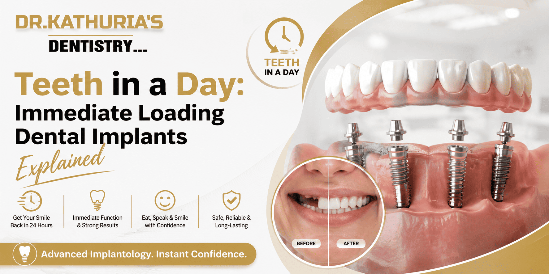 Teeth in a Day: Immediate Loading Dental Implants Explained