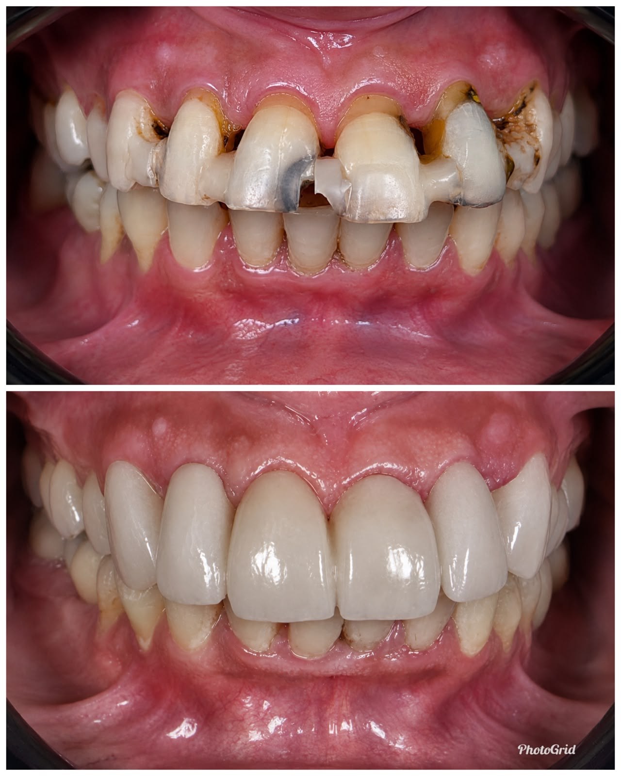 Metal Free Crowns & Bridges (Zirconia) Case
