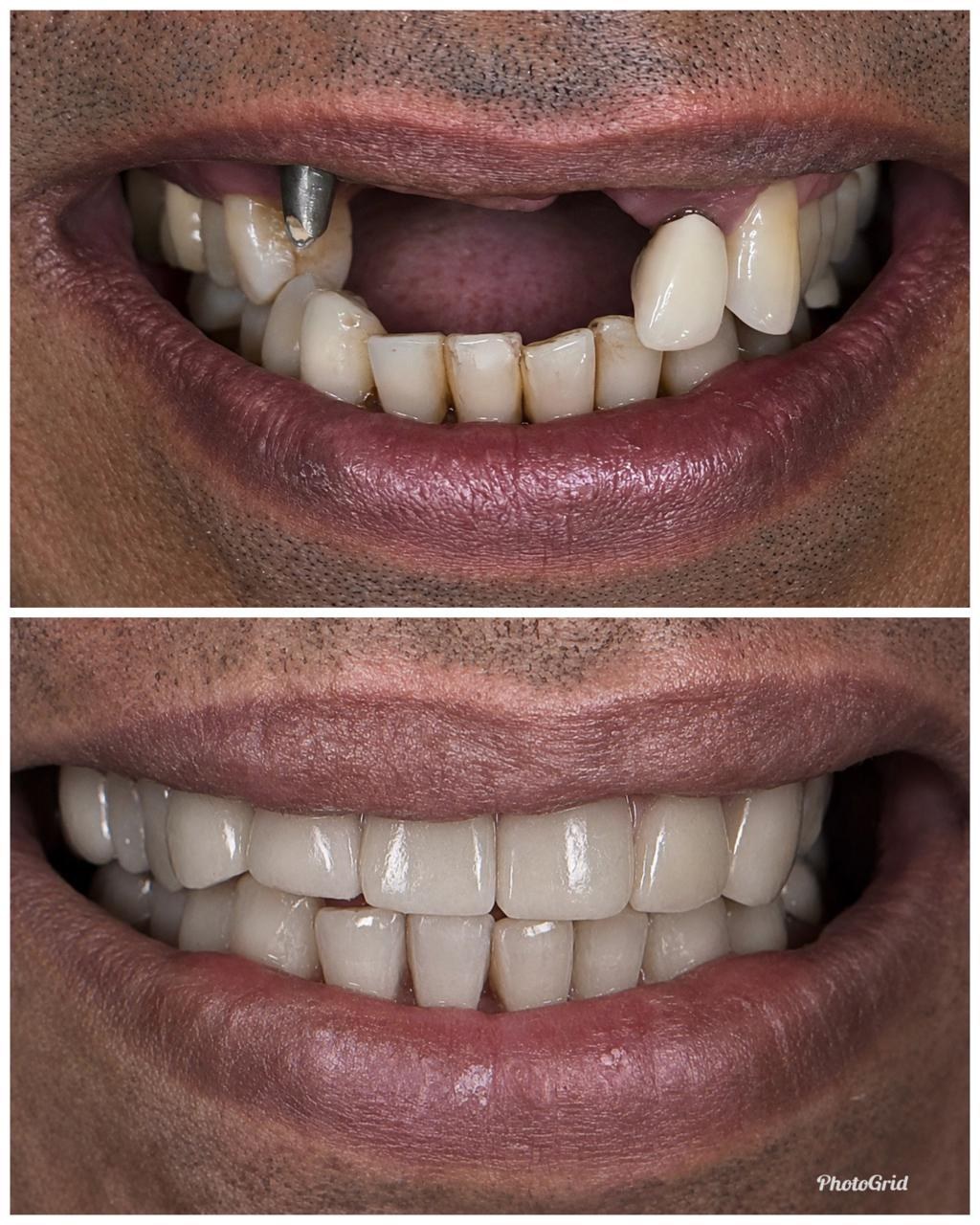 Metal Free Crowns & Bridges (Zirconia) Case