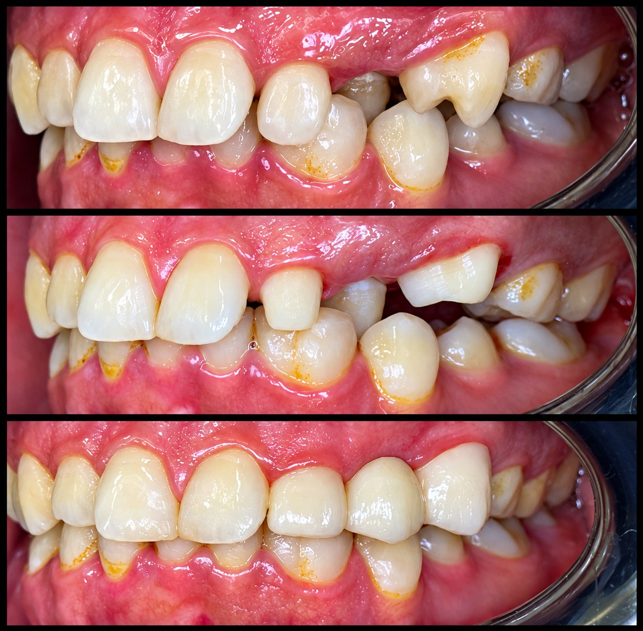 Metal Free Crowns & Bridges (Zirconia) Case