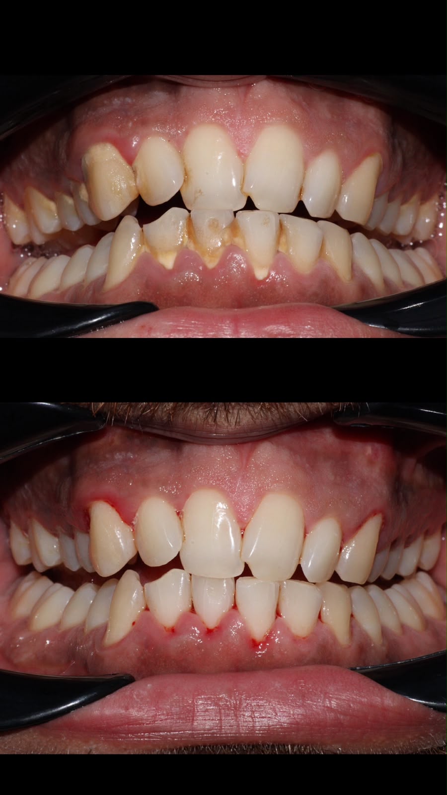 Full Mouth Scaling & Polishing Case