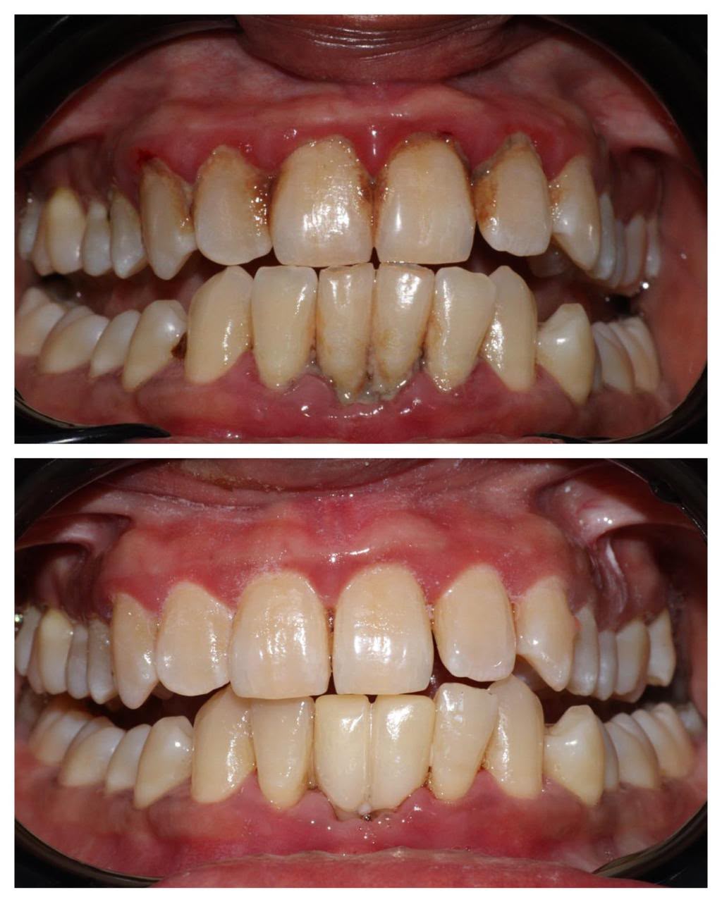 Full Mouth Scaling & Polishing Case