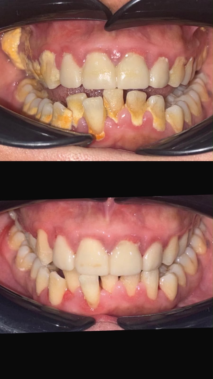 Full Mouth Scaling & Polishing Case
