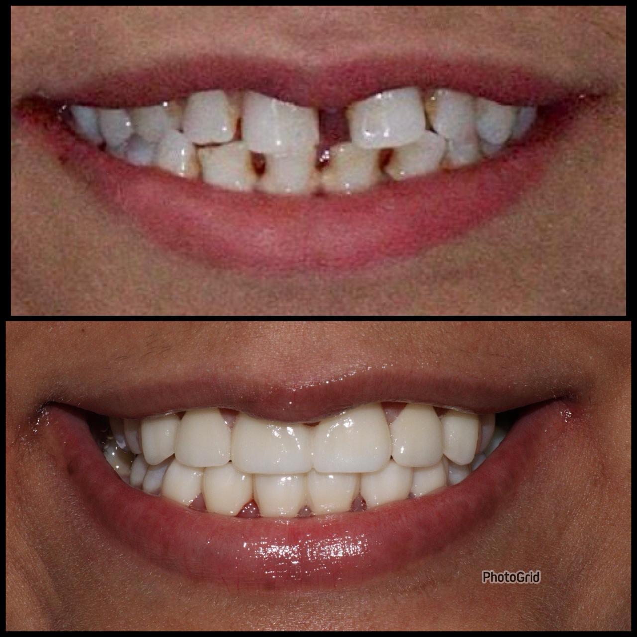 Gap Closure Case