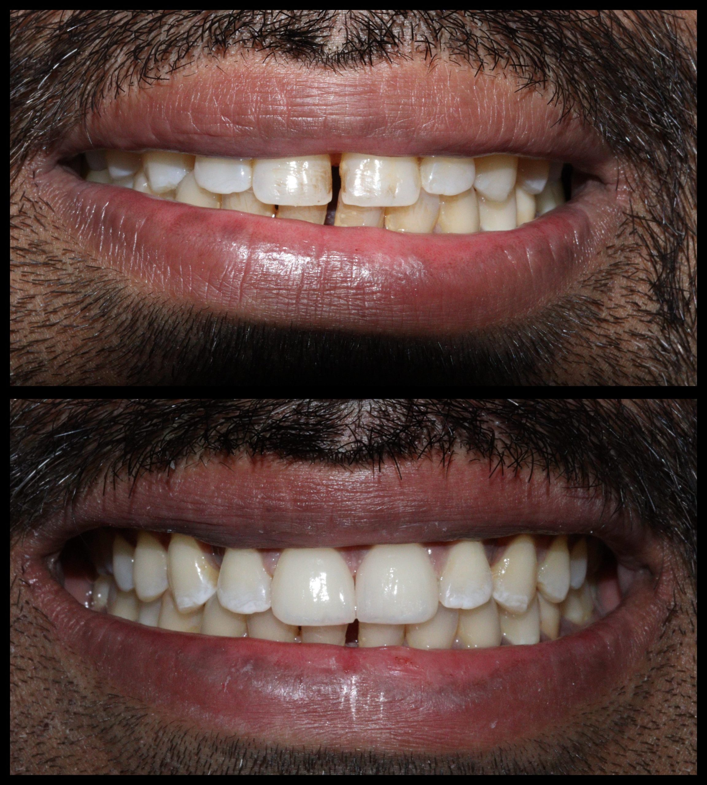 Gap Closure Case