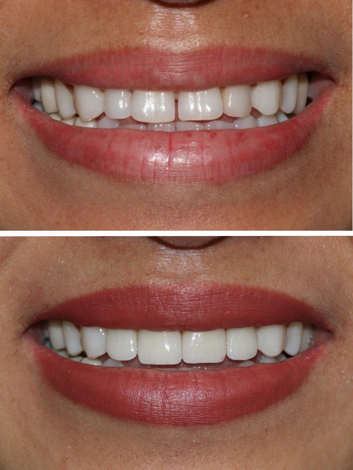 Gap Closure Case