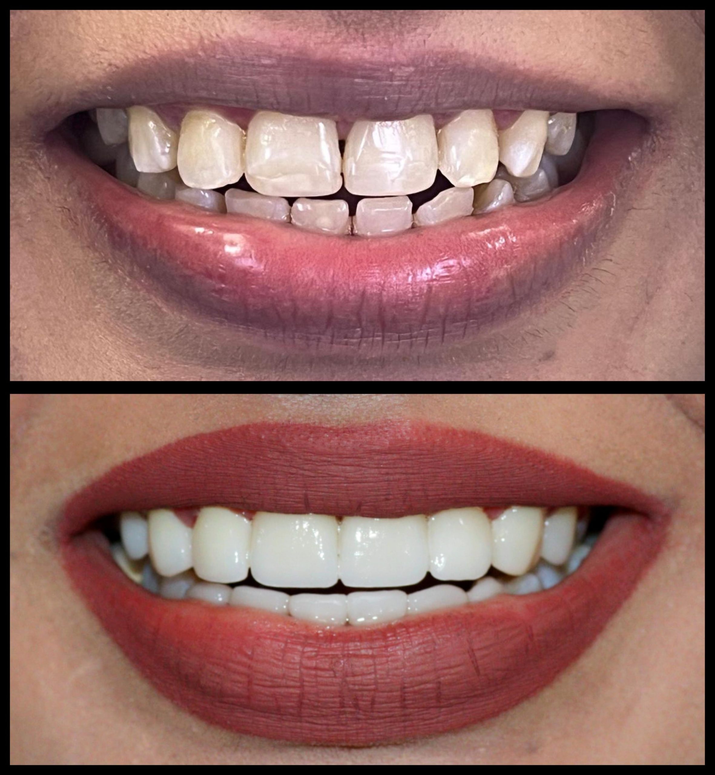 Gap Closure Case