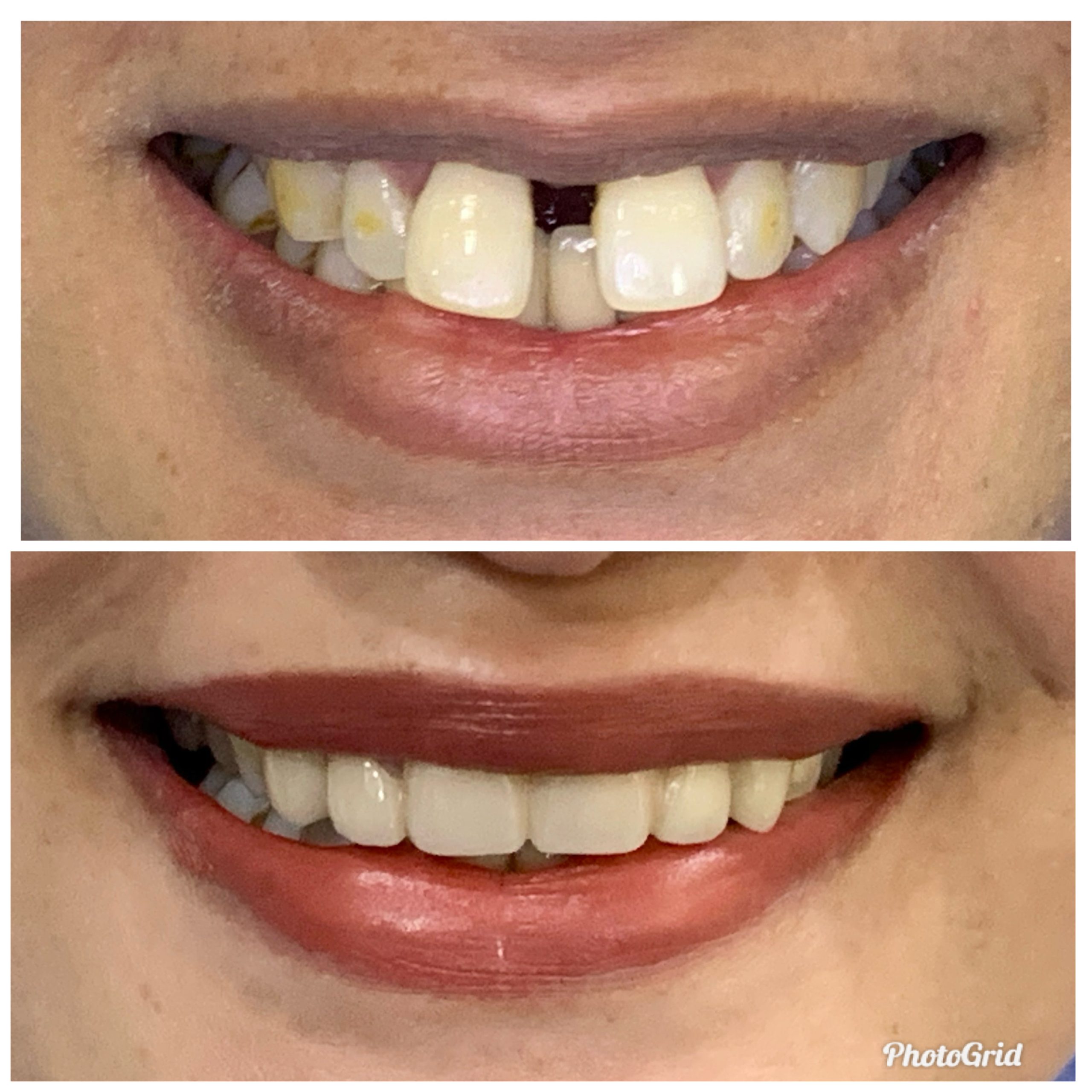 Gap Closure Case