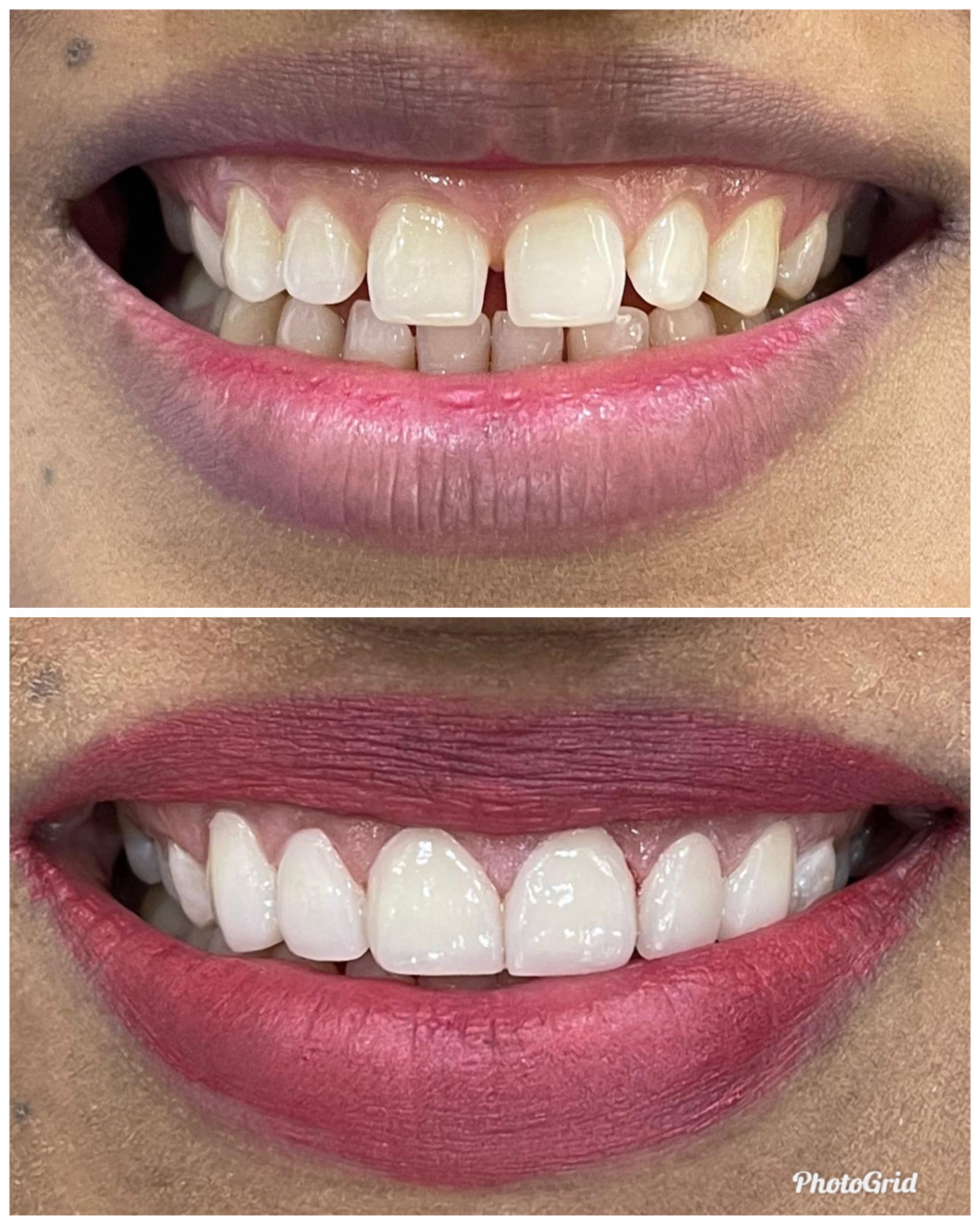 Gap Closure Case